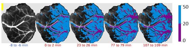 Laser speckle imaging of the brain before and after stroke. Healthy tissue (CBF >50 % of pre-stroke values) shown in gray scales. Peri-ischemic area shown in blue and ischemic core (CBF <20 % of pre-stroke values) in purple. Each panel corresponds to different times relative to stroke. Black scale bar = 1 mm.